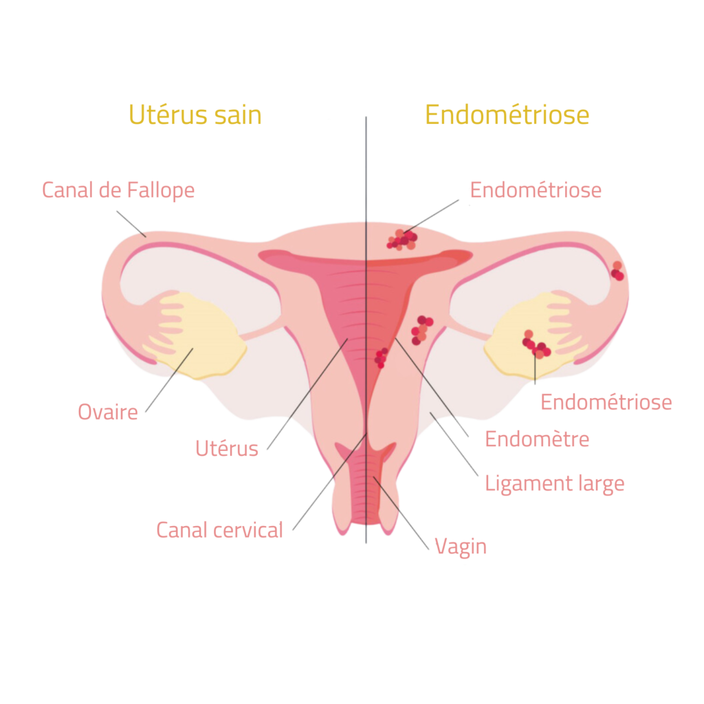 Qu'est ce que l'endométriose ? 1 schéma endométriose